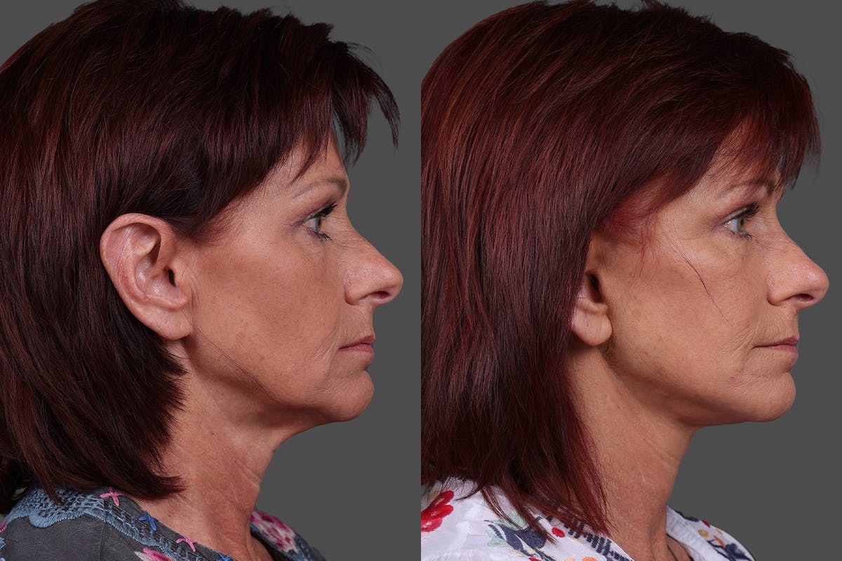 Eyelid Surgery (Blepharoplasty) Before & After Gallery - Patient 278930 - Image 3