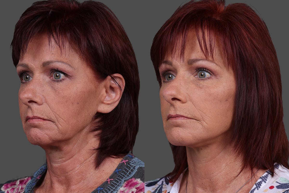 Eyelid Surgery (Blepharoplasty) Before & After Gallery - Patient 278930 - Image 4