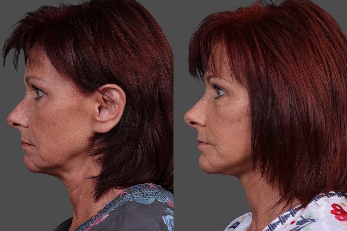 Eyelid Surgery (Blepharoplasty) Before & After Gallery - Patient 278930 - Image 5