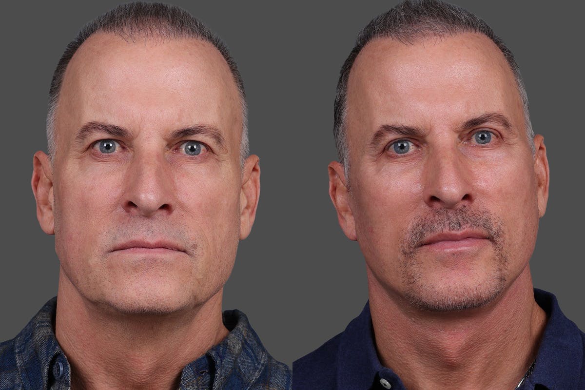 Eyelid Surgery (Blepharoplasty) Before & After Gallery - Patient 386131 - Image 1