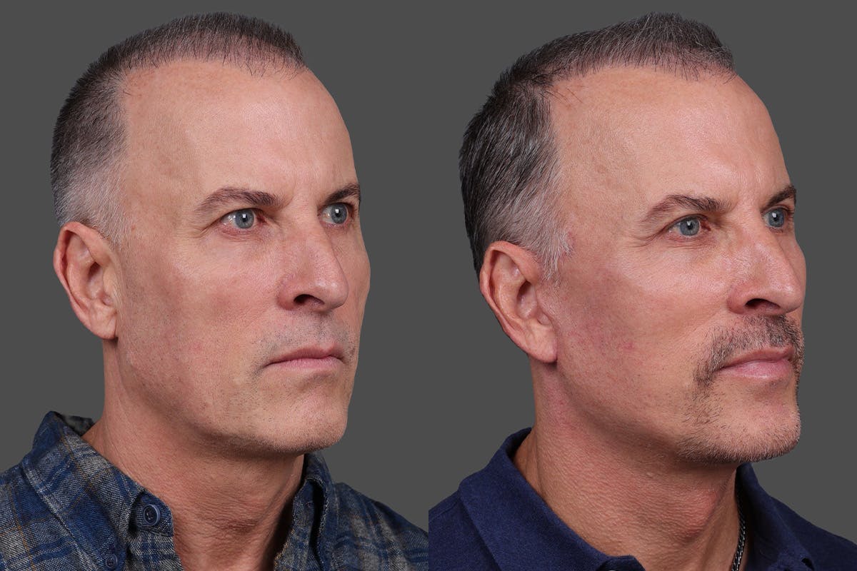 Eyelid Surgery (Blepharoplasty) Before & After Gallery - Patient 386131 - Image 2