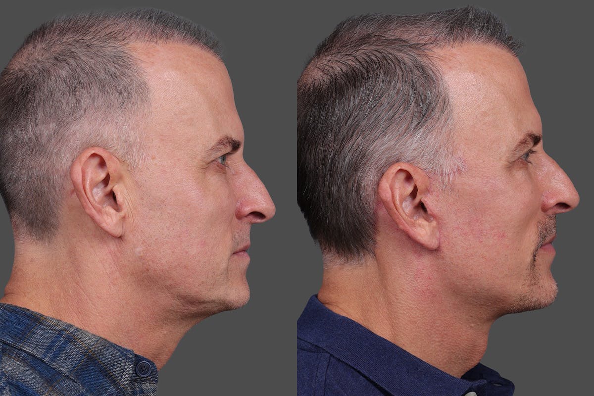 Eyelid Surgery (Blepharoplasty) Before & After Gallery - Patient 386131 - Image 3