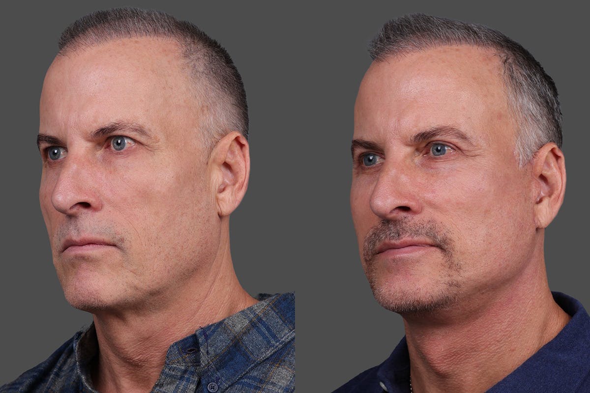 Eyelid Surgery (Blepharoplasty) Before & After Gallery - Patient 386131 - Image 4