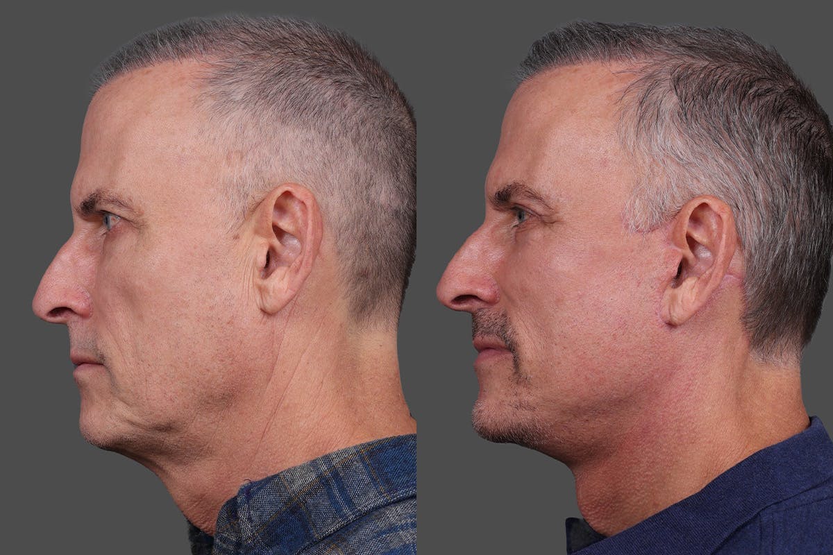 Eyelid Surgery (Blepharoplasty) Before & After Gallery - Patient 386131 - Image 5