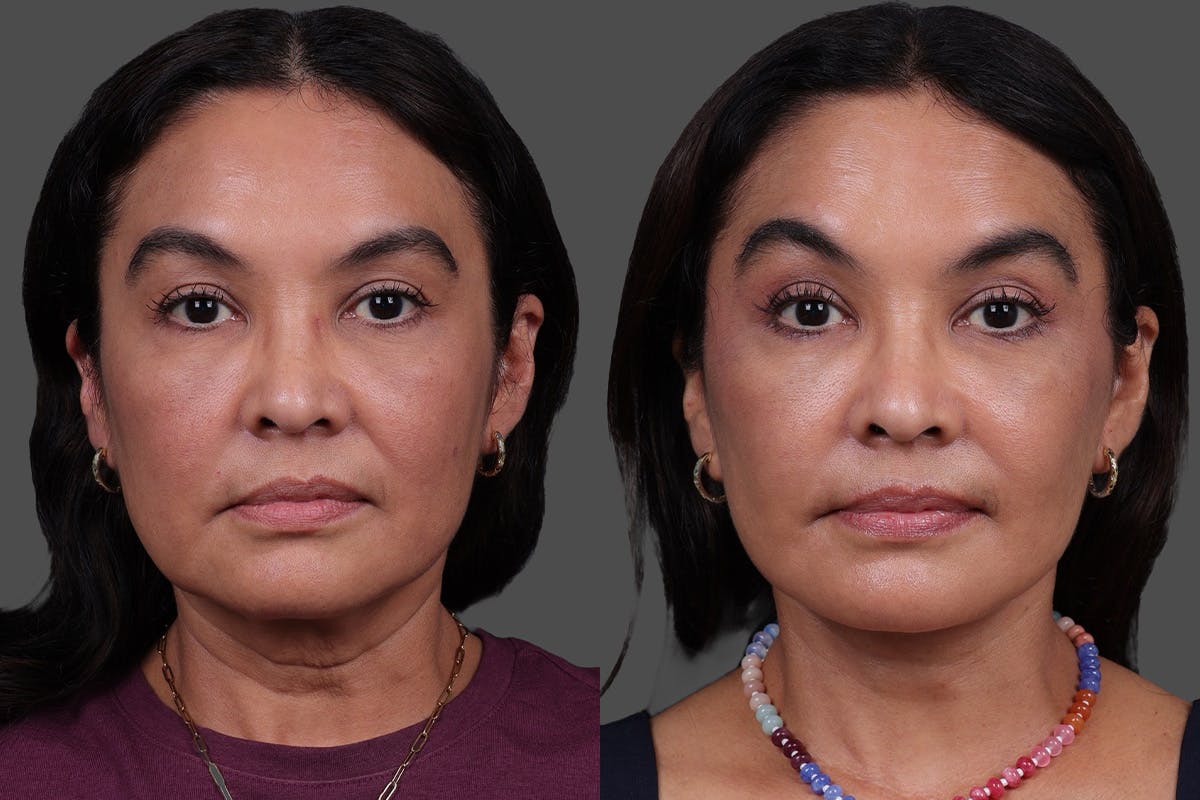 Facelift Before & After Gallery - Patient 112771 - Image 1