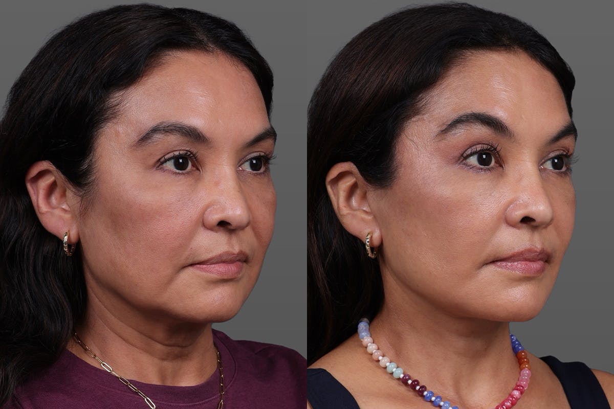 Facelift Before & After Gallery - Patient 112771 - Image 2