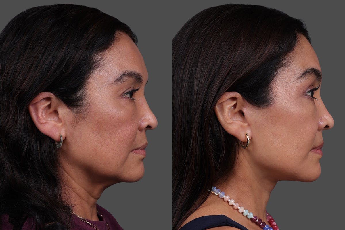 Facelift Before & After Gallery - Patient 112771 - Image 3