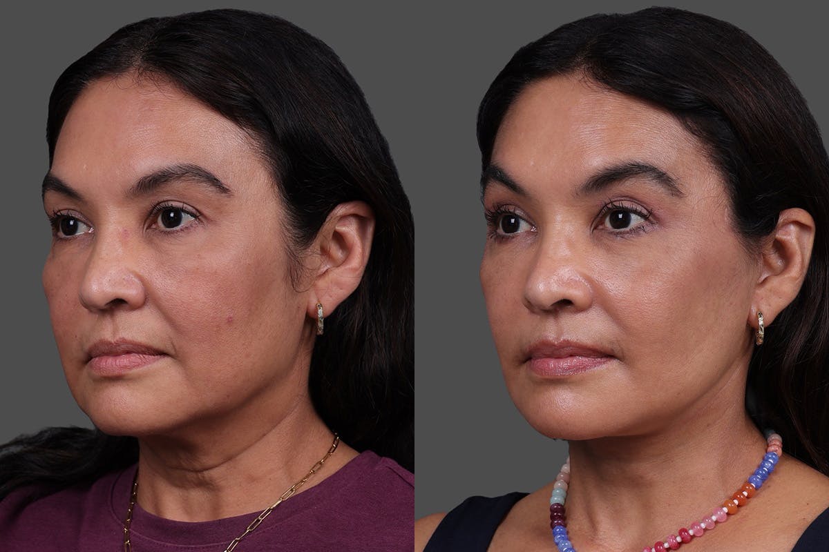 Facelift Before & After Gallery - Patient 112771 - Image 4