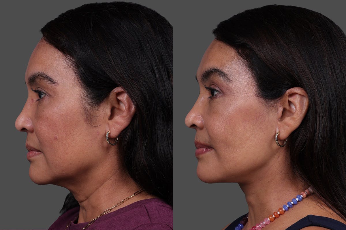 Facelift Before & After Gallery - Patient 112771 - Image 5
