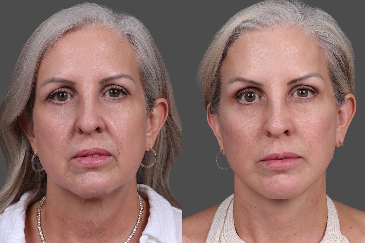 Endoscopic Brow Lift Before & After Gallery - Patient 625961 - Image 1