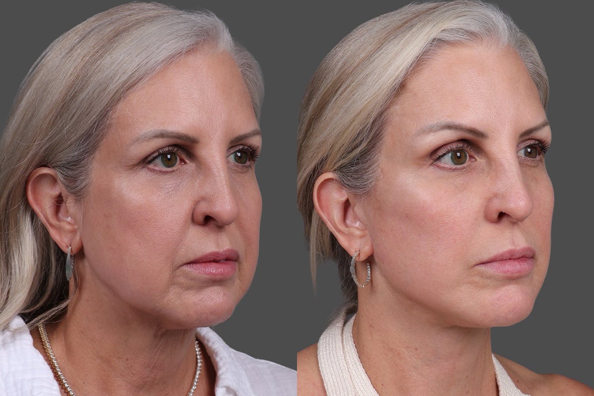 Endoscopic Brow Lift Before & After Gallery - Patient 625961 - Image 2