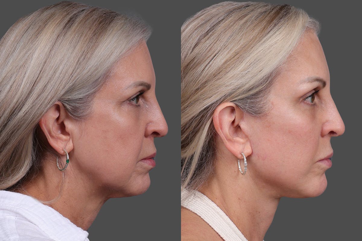Endoscopic Brow Lift Before & After Gallery - Patient 625961 - Image 3