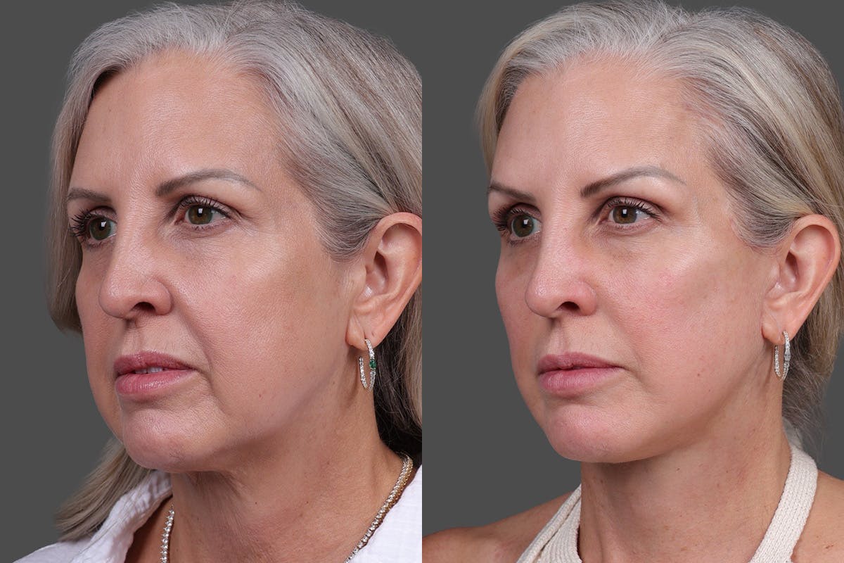 Endoscopic Brow Lift Before & After Gallery - Patient 625961 - Image 5
