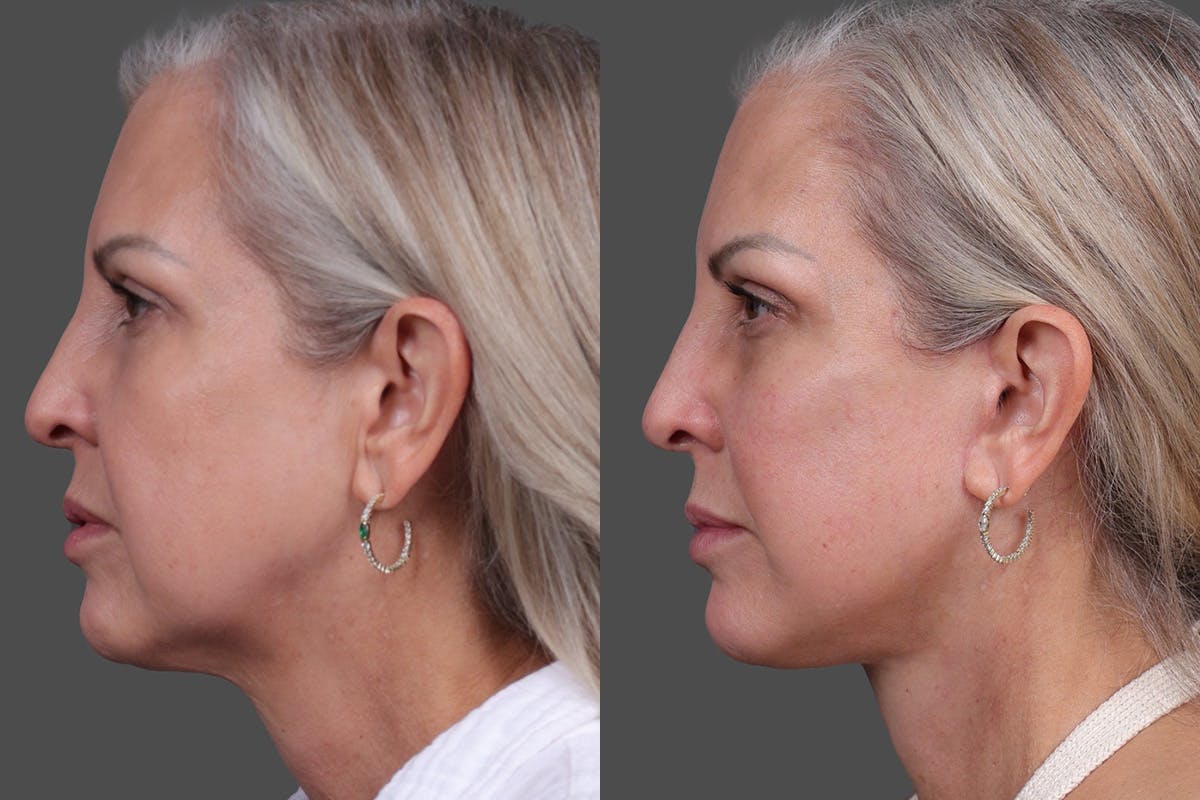 Endoscopic Brow Lift Before & After Gallery - Patient 625961 - Image 4