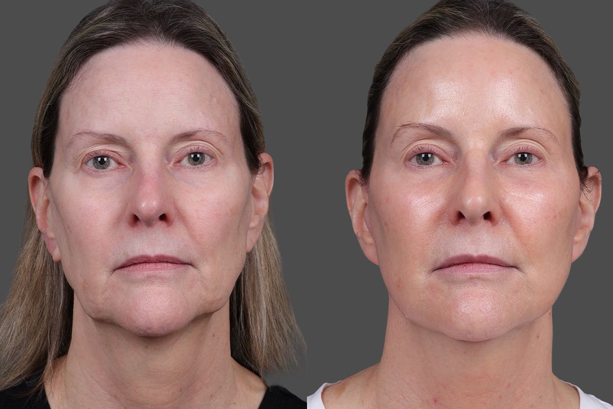 Limited Incision Facelift Before & After Gallery - Patient 374570 - Image 1