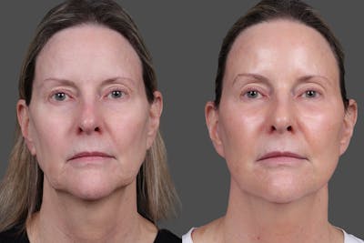 Limited Incision Facelift Before & After Gallery - Patient 374570 - Image 1