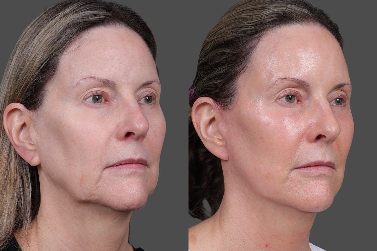 Limited Incision Facelift Before & After Gallery - Patient 374570 - Image 2