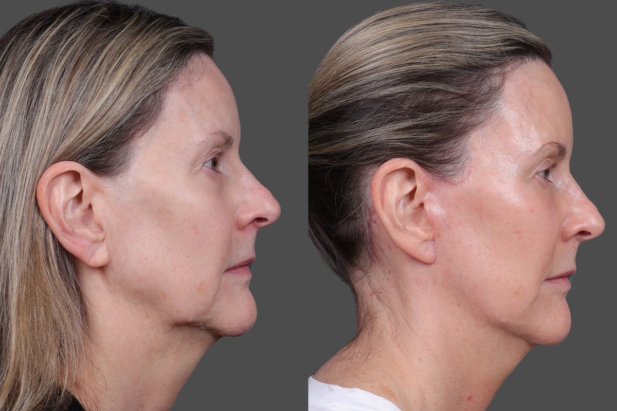 Limited Incision Facelift Before & After Gallery - Patient 374570 - Image 3
