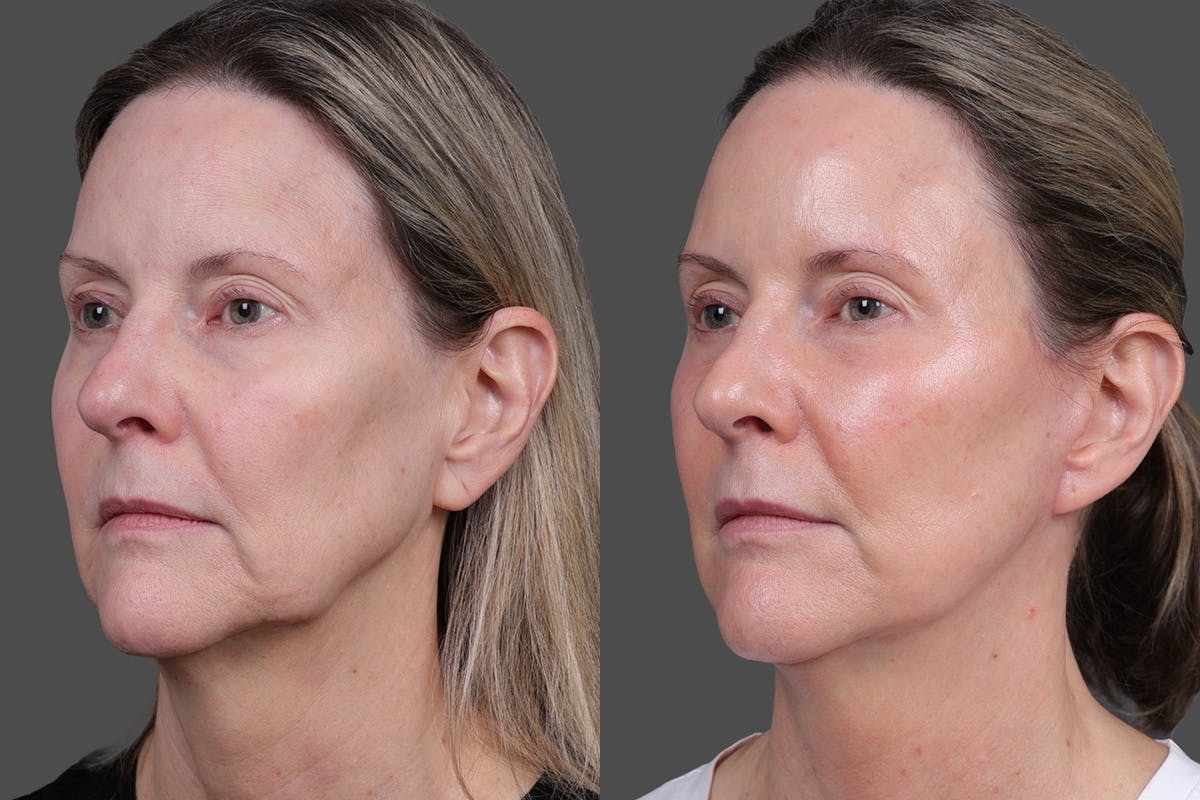 Limited Incision Facelift Before & After Gallery - Patient 374570 - Image 4