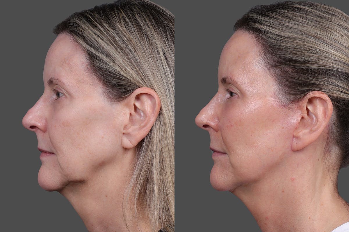 Limited Incision Facelift Before & After Gallery - Patient 374570 - Image 5