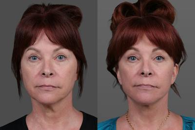 Facial Fat Transfer Before & After Gallery - Patient 219277 - Image 1