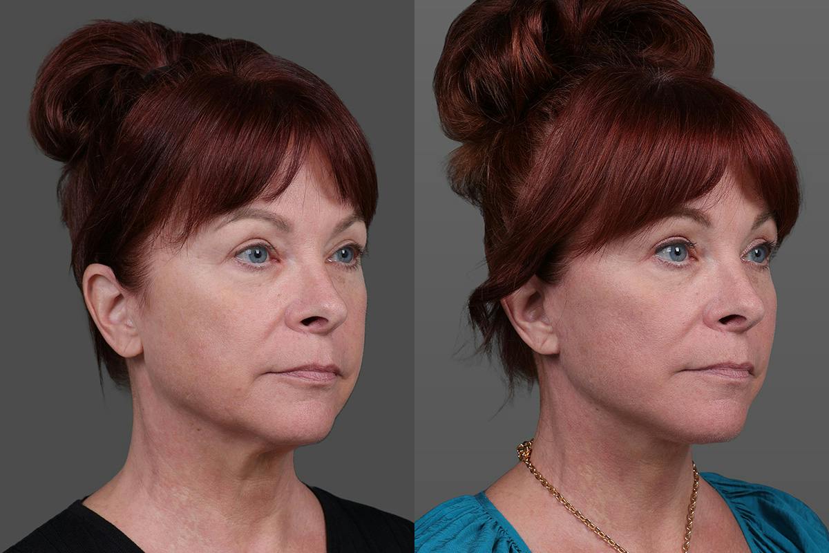 Facial Fat Transfer Before & After Gallery - Patient 219277 - Image 2
