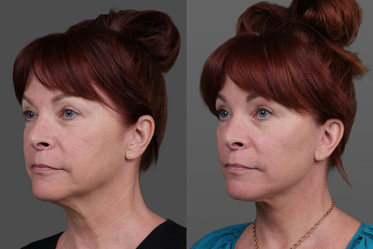 Facial Fat Transfer Before & After Gallery - Patient 219277 - Image 4