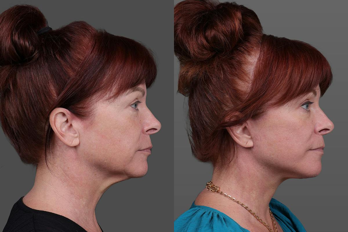 Facial Fat Transfer Before & After Gallery - Patient 219277 - Image 3