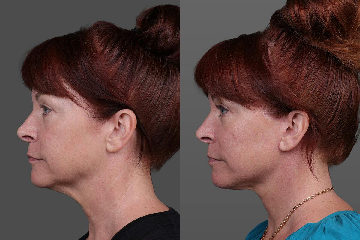Facial Fat Transfer Before & After Gallery - Patient 219277 - Image 5