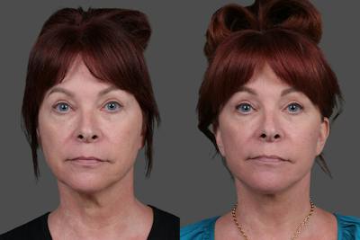 Facelift Before & After Gallery - Patient 113592 - Image 1