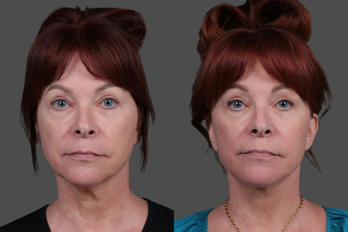 Facial Fat Transfer Before & After Gallery - Patient 219277 - Image 1