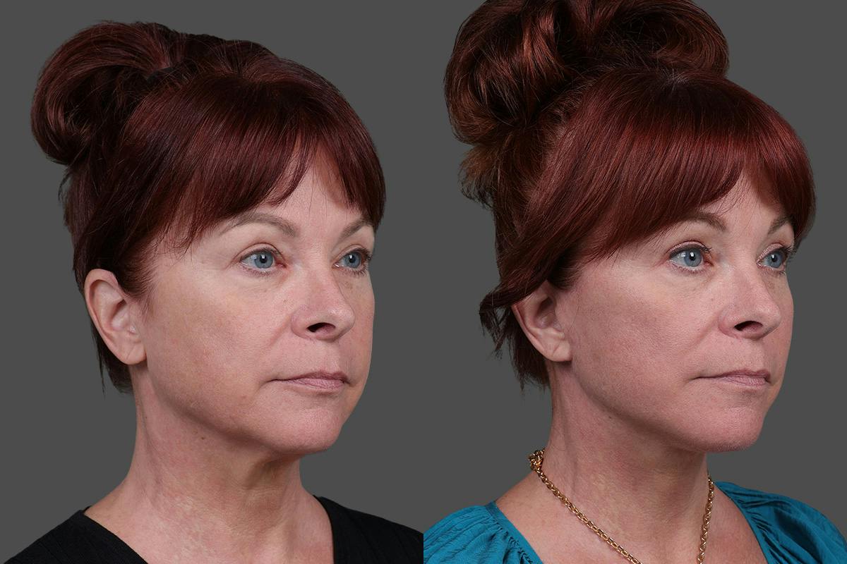Facial Fat Transfer Before & After Gallery - Patient 219277 - Image 2
