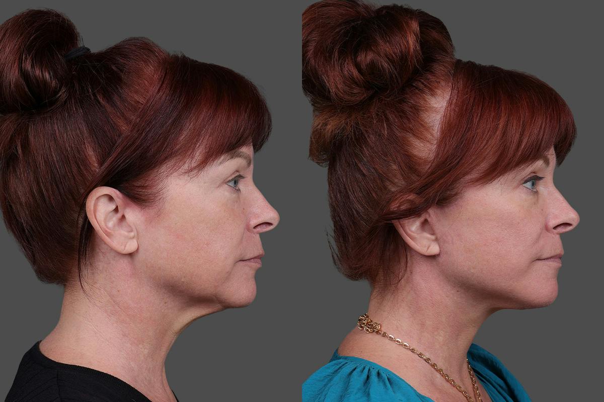 Facial Fat Transfer Before & After Gallery - Patient 219277 - Image 3