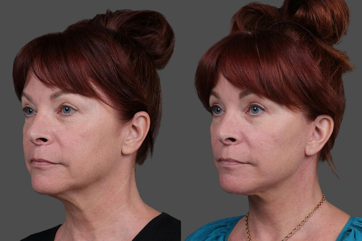 Facial Fat Transfer Before & After Gallery - Patient 219277 - Image 4