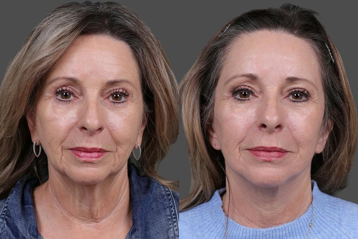 Earlobe Reduction Before & After Gallery - Patient 280808 - Image 1
