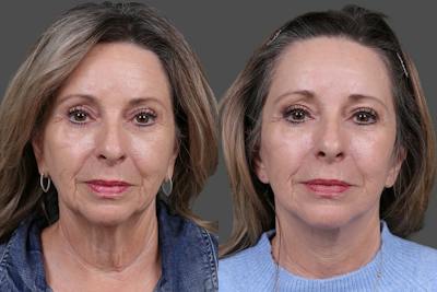 Earlobe Reduction Before & After Gallery - Patient 280808 - Image 1