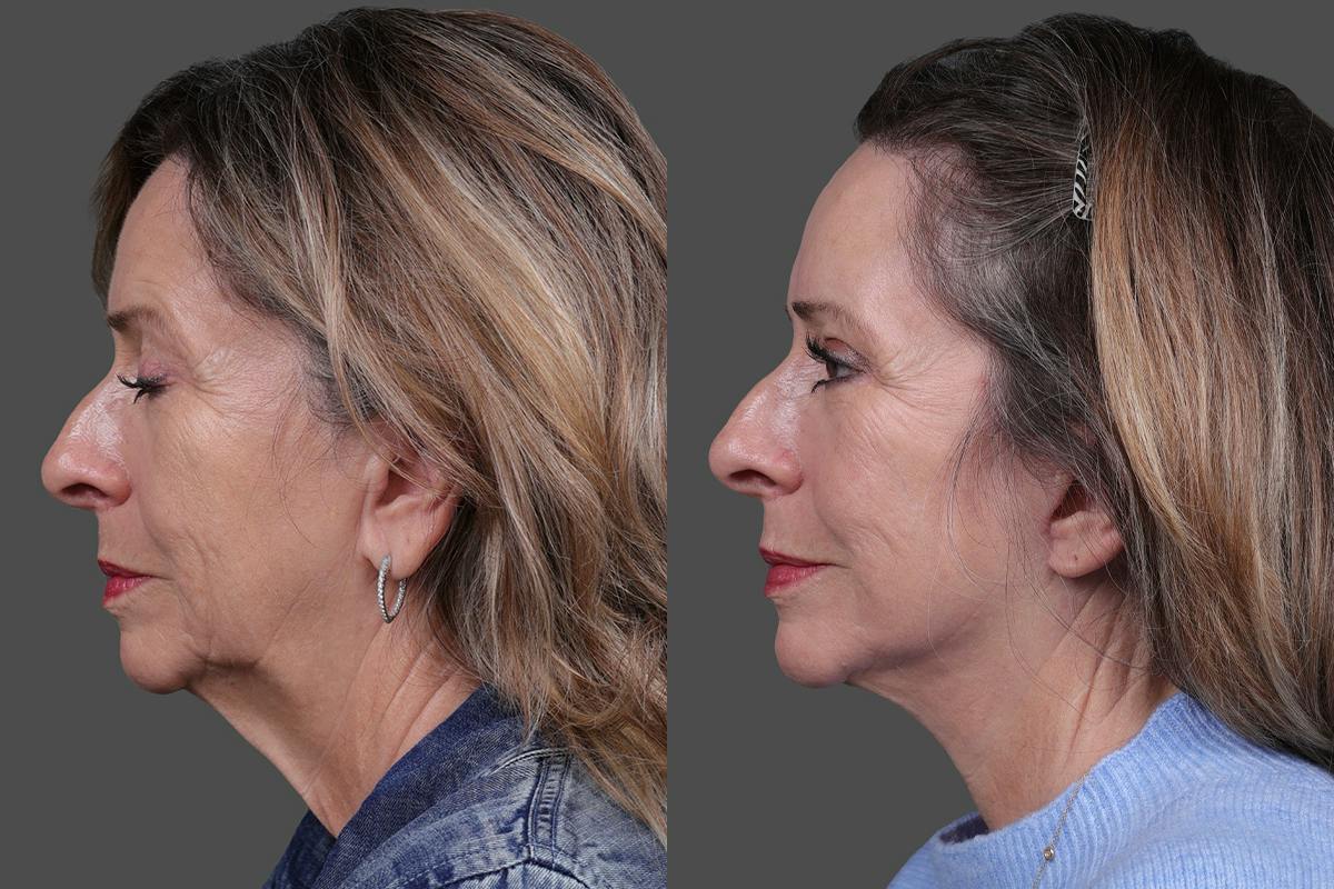 Earlobe Reduction Before & After Gallery - Patient 280808 - Image 5