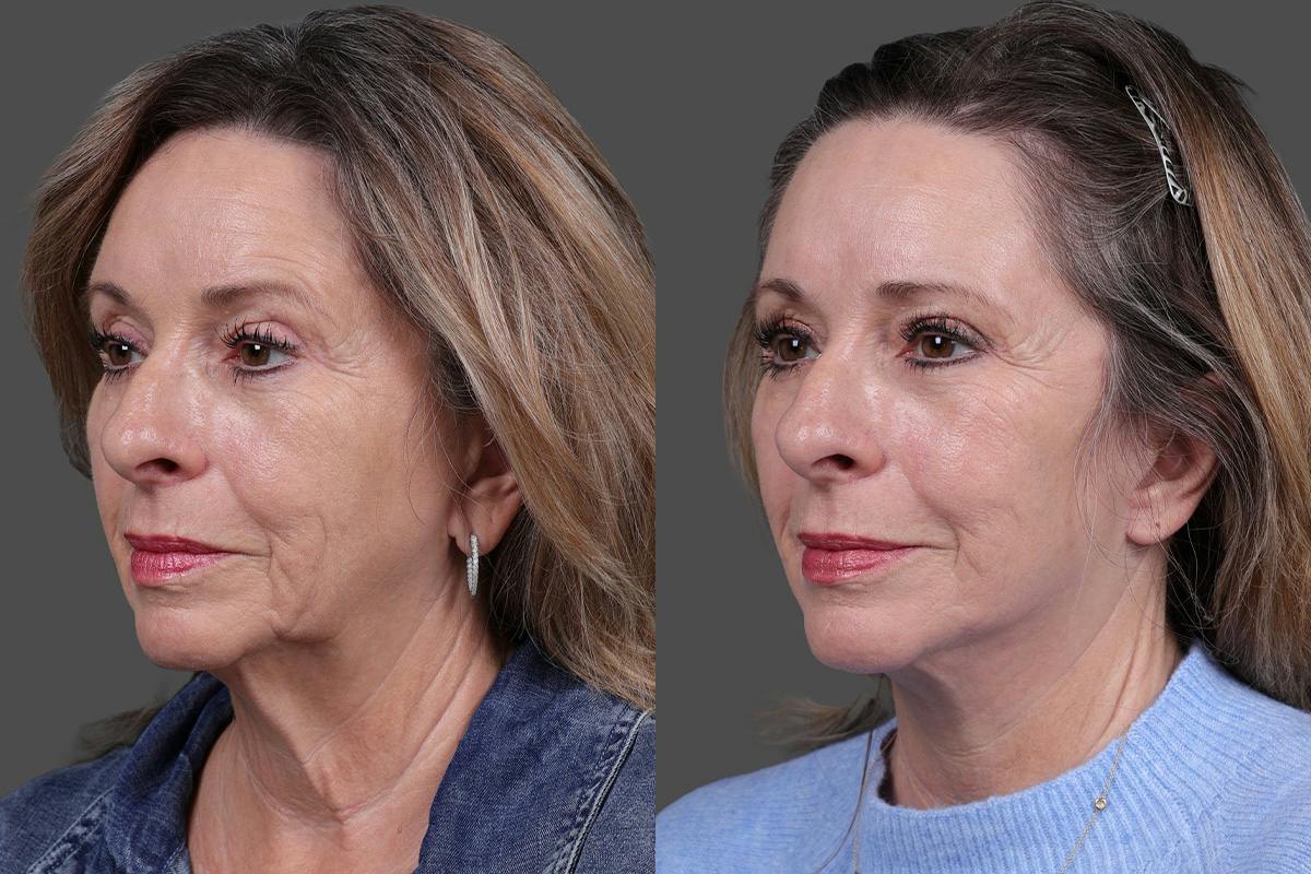 Earlobe Reduction Before & After Gallery - Patient 280808 - Image 4
