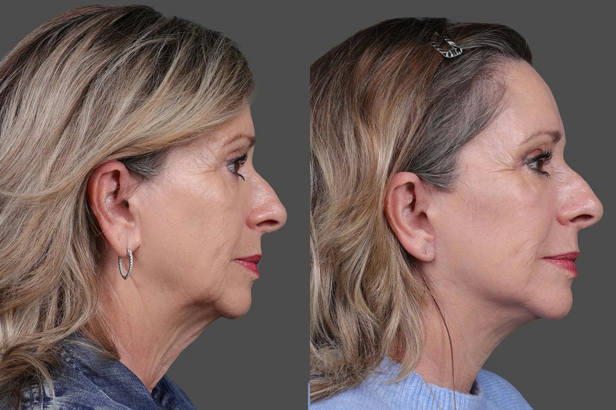 Earlobe Reduction Before & After Gallery - Patient 280808 - Image 3