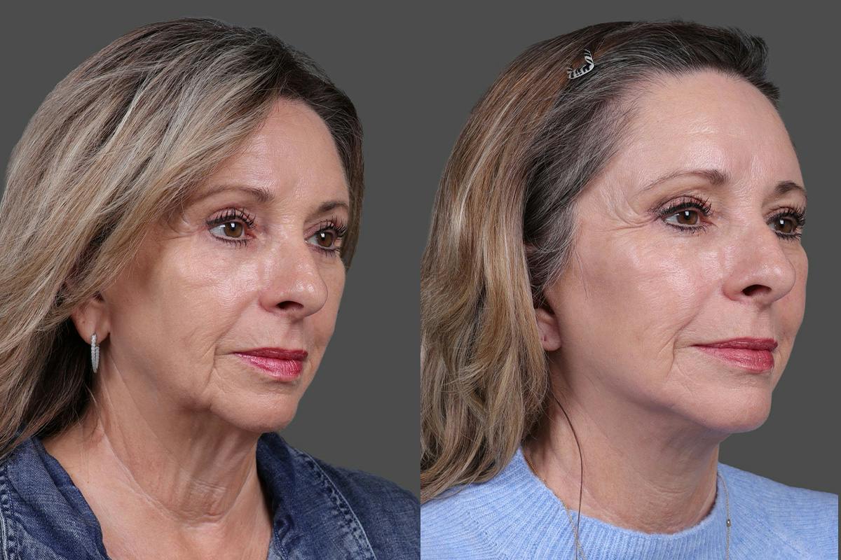 Earlobe Reduction Before & After Gallery - Patient 280808 - Image 2