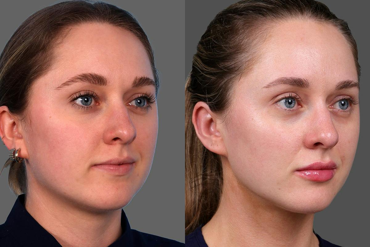 Moxi® Before & After Gallery - Patient 201789 - Image 2
