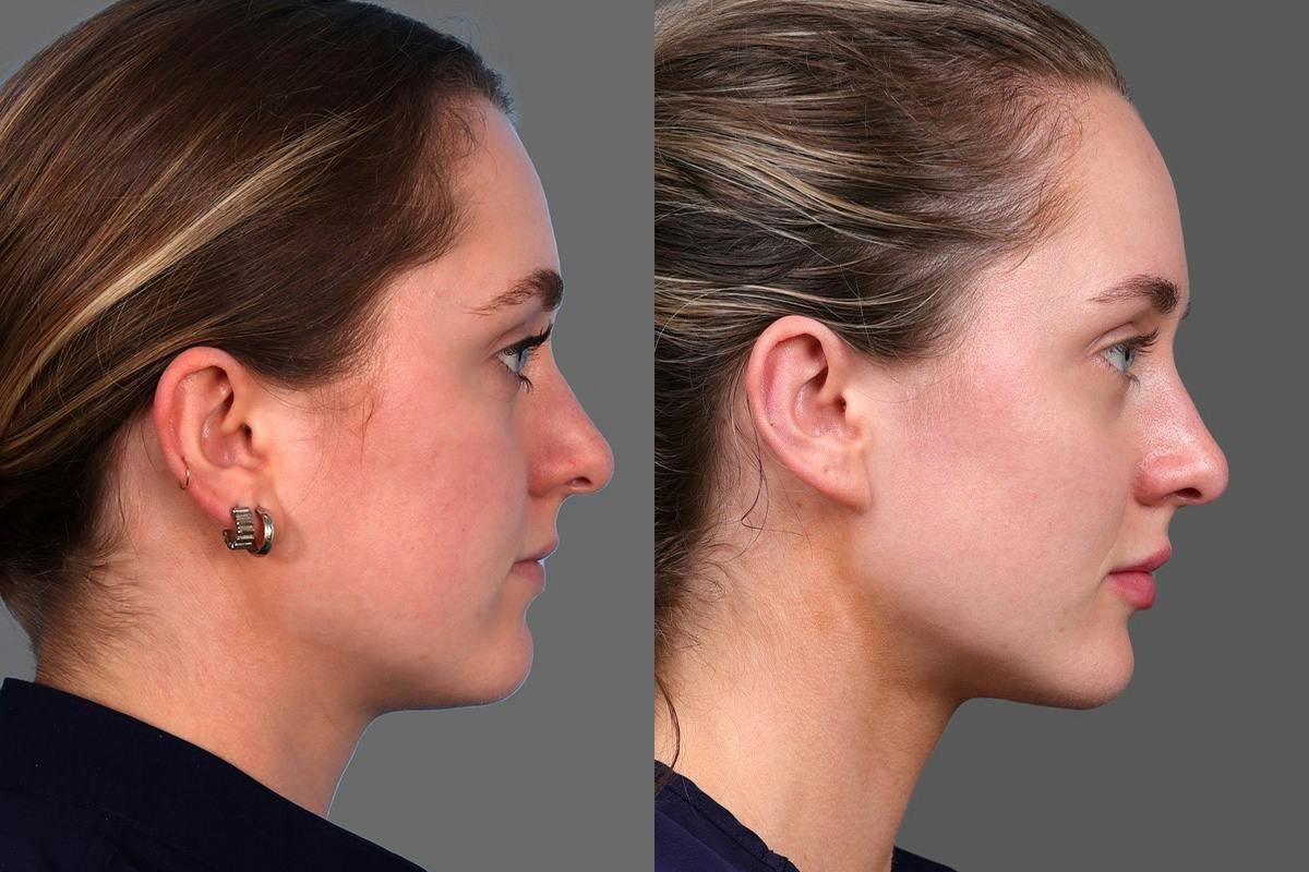Moxi® Before & After Gallery - Patient 201789 - Image 3