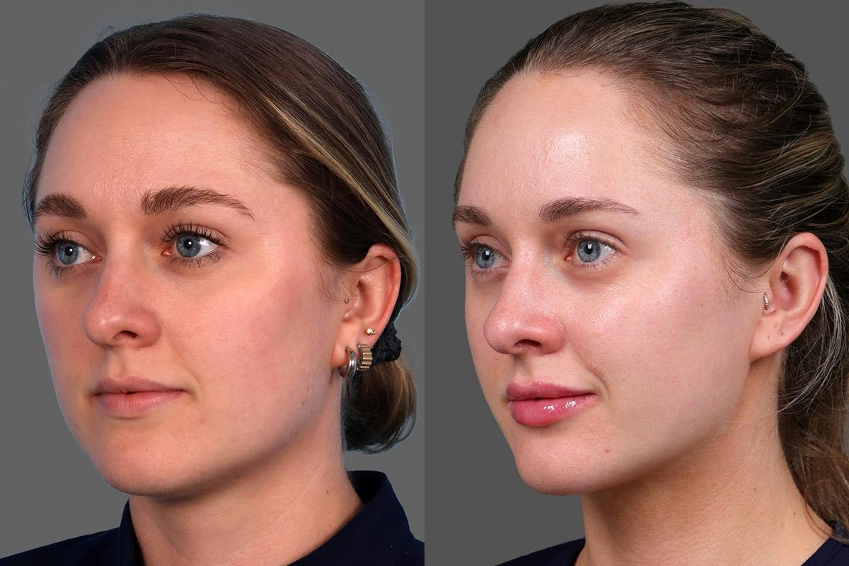 Moxi® Before & After Gallery - Patient 201789 - Image 4