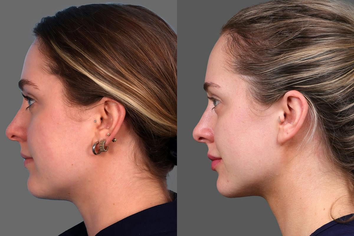 Moxi® Before & After Gallery - Patient 201789 - Image 5