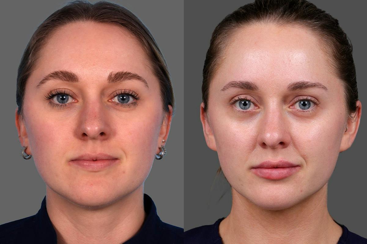 Moxi® Before & After Gallery - Patient 201789 - Image 1