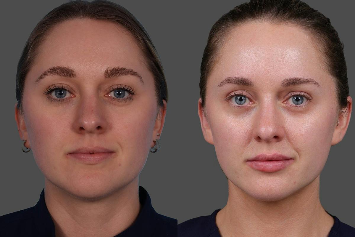 Moxi® Before & After Gallery - Patient 201789 - Image 1