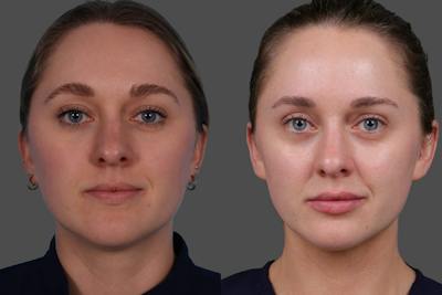Sculptra® Before & After Gallery - Patient 473804 - Image 1