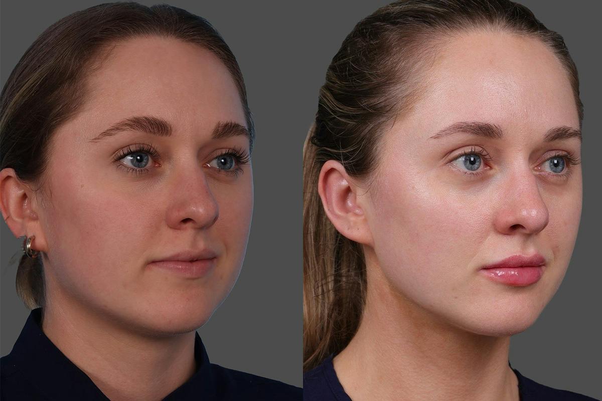 Moxi® Before & After Gallery - Patient 201789 - Image 2
