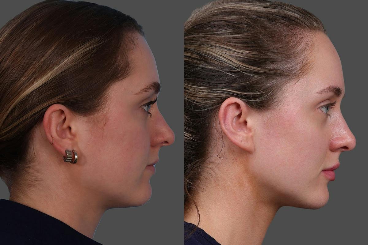 Moxi® Before & After Gallery - Patient 201789 - Image 3