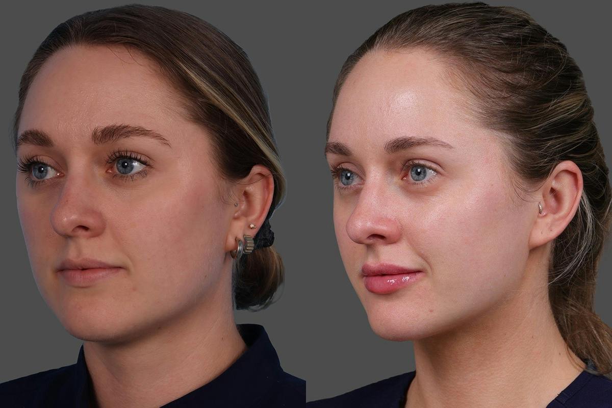 Moxi® Before & After Gallery - Patient 201789 - Image 4